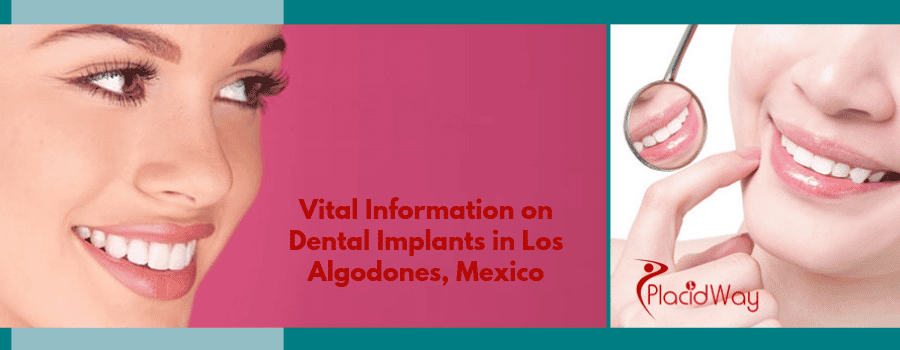Dental Implants in Los Algodones, Mexico